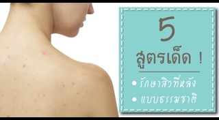 วิธีรักษาสิวแบบธรรมชาติ