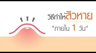 วิธีรักษาสิวแบบธรรมชาติ