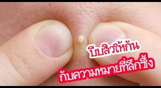 บีบสิว