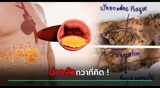 ไขมันในเลือดสูง