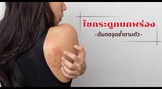 โรค MDS