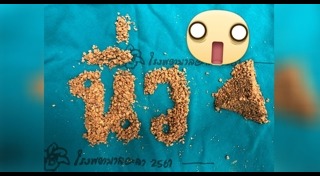 นิ่วในถุงน้ำดี