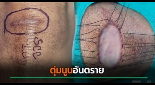 มะเร็งผิวหนัง