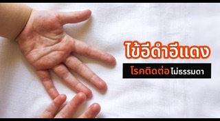 โรคติดต่อในเด็ก