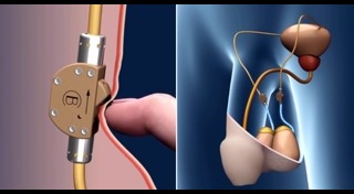 ทำหมันชาย