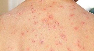 อีสุกอีใส