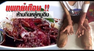 ไข้หูดับ