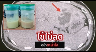 เบื่ออาหาร