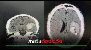 เส้นเลือดสมองแตก