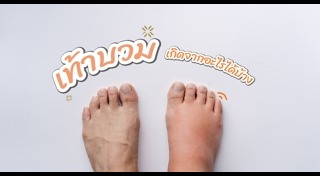 อาการบวมน้ำ