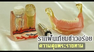 รากฟันเทียม