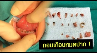 ฟันผุเสี่ยงโรค