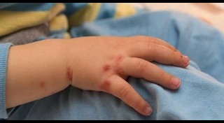 โรคติดต่อในเด็ก