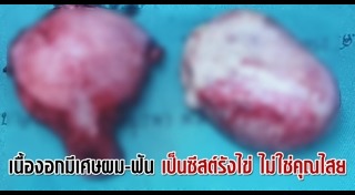 ซีสต์
