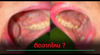 เชื้อ HIV