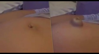 ไส้เลื่อน