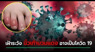 ผิวหนังอักเสบ