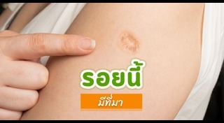 รอยแผลเป็น