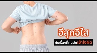 อีสุกอีใส
