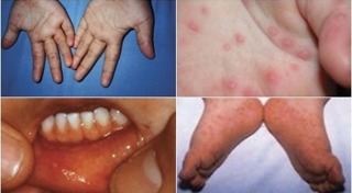 โรคมือเท้าปาก