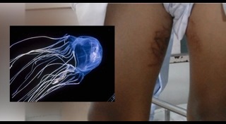 แมงกะพรุนกล่อง