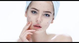 วิธีรักษาหลุมสิว