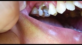 น้ำเกลือ