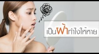 ฝ้า