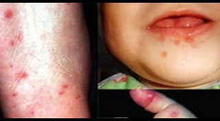 โรคติดต่อในเด็ก