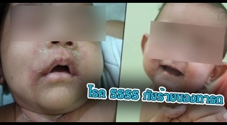 โรคติดต่อในเด็ก