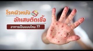 ภูมิแพ้ผิวหนัง