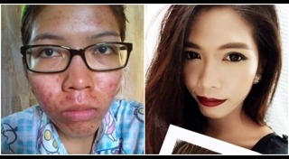 วิธีรักษาหลุมสิว