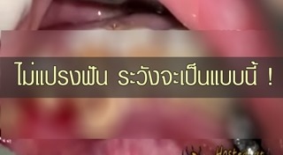 ขูดหินปูน