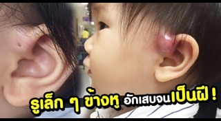 โรคหูอักเสบ