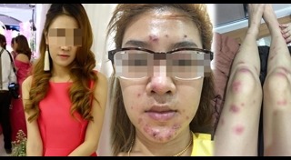 ฉีดผิวขาว