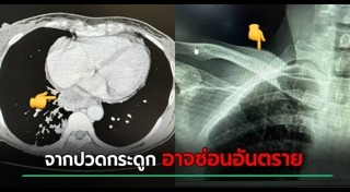 มะเร็ง