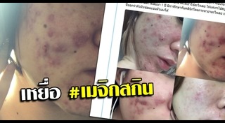 แพ้เครื่องสำอาง