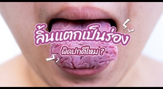 อาการแสบลิ้น