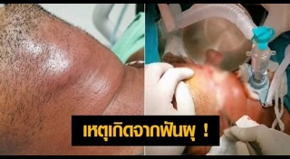 ฟันผุเสี่ยงโรค