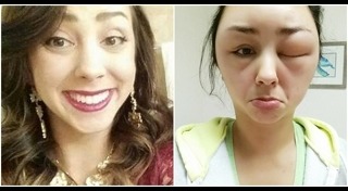 หน้าบวม