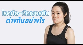 โรคหัด