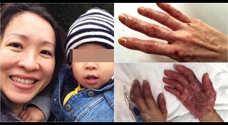 โรคมือเท้าปาก