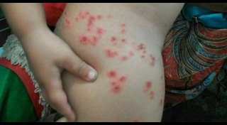 โรคติดต่อในเด็ก