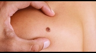 มะเร็งผิวหนัง