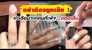 จมูกเล็บ