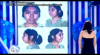 เสริมคาง