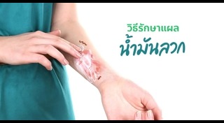 วิธีรักษาน้ำมันลวก