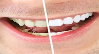 เสียวฟัน