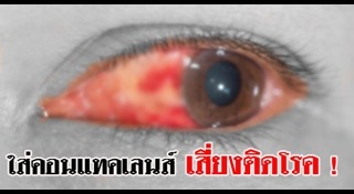 คอนแทคเลนส์