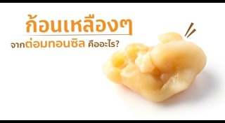 นิ่วทอนซิล